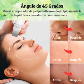 SkinWave Pro™ - Exfoliador Ultrasónico